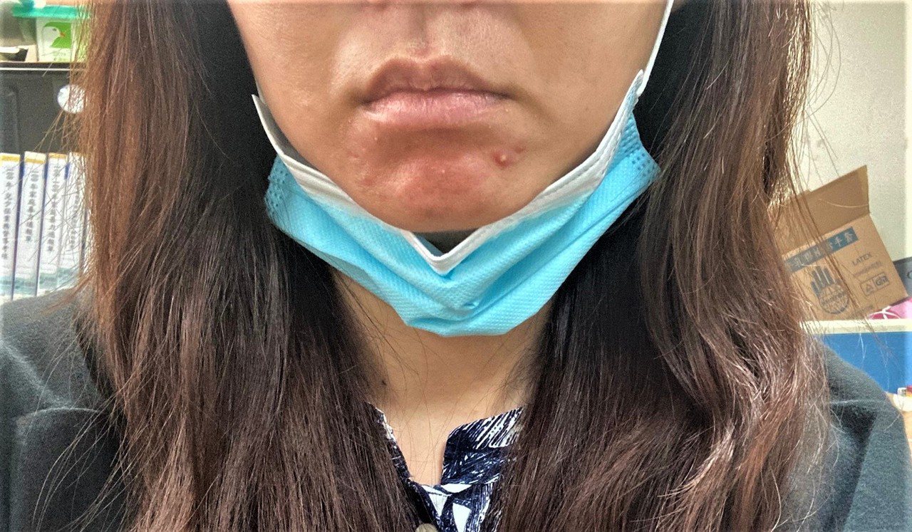 南投縣32歲陳姓女子因長時間戴口罩，導致嘴邊和下巴狂冒痘，還長出一堆粉刺。圖／南投醫院提供