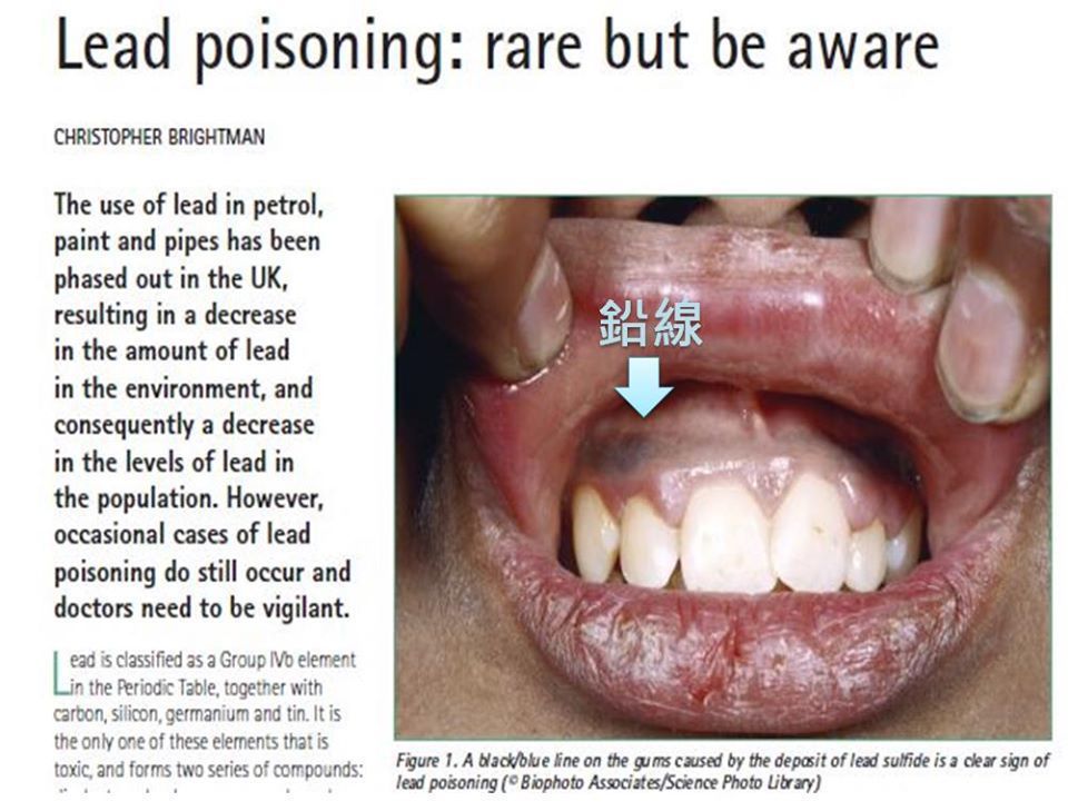 鉛中毒的患者牙齦處可見灰黑色的線狀鉛沈積。。圖／取自網路