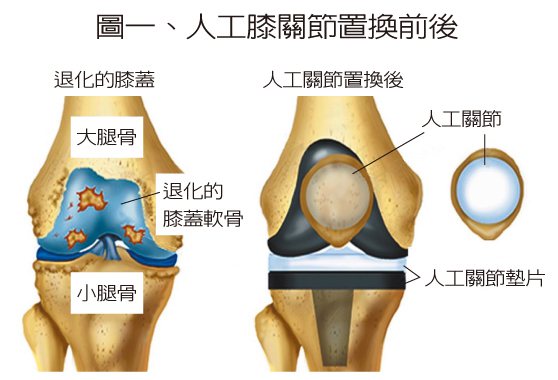 圖一、人工膝關節置換前後 圖／陳志鎧提供