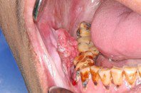 頰黏膜腫瘤，同時亦可看見黏膜下纖維化、牙齒磨耗、牙周病等。