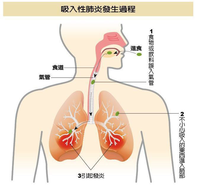 吸入性肺炎發生過程 製表/元氣周報 圖/123RF