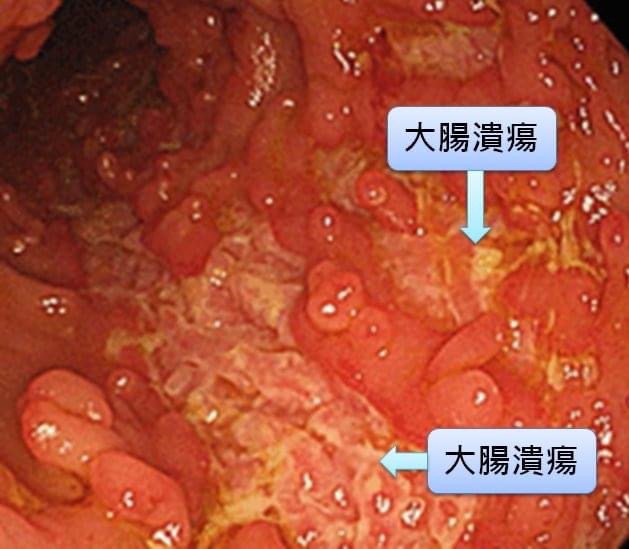 日本首相安倍晉三罹患亞洲人不常見的潰瘍性大腸炎。圖／安南醫院提供