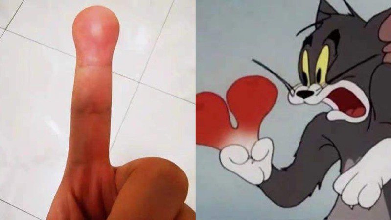 網友的手指頭與卡通「湯姆貓與傑利鼠」腫的一樣。圖／翻攝自爆廢公社二館