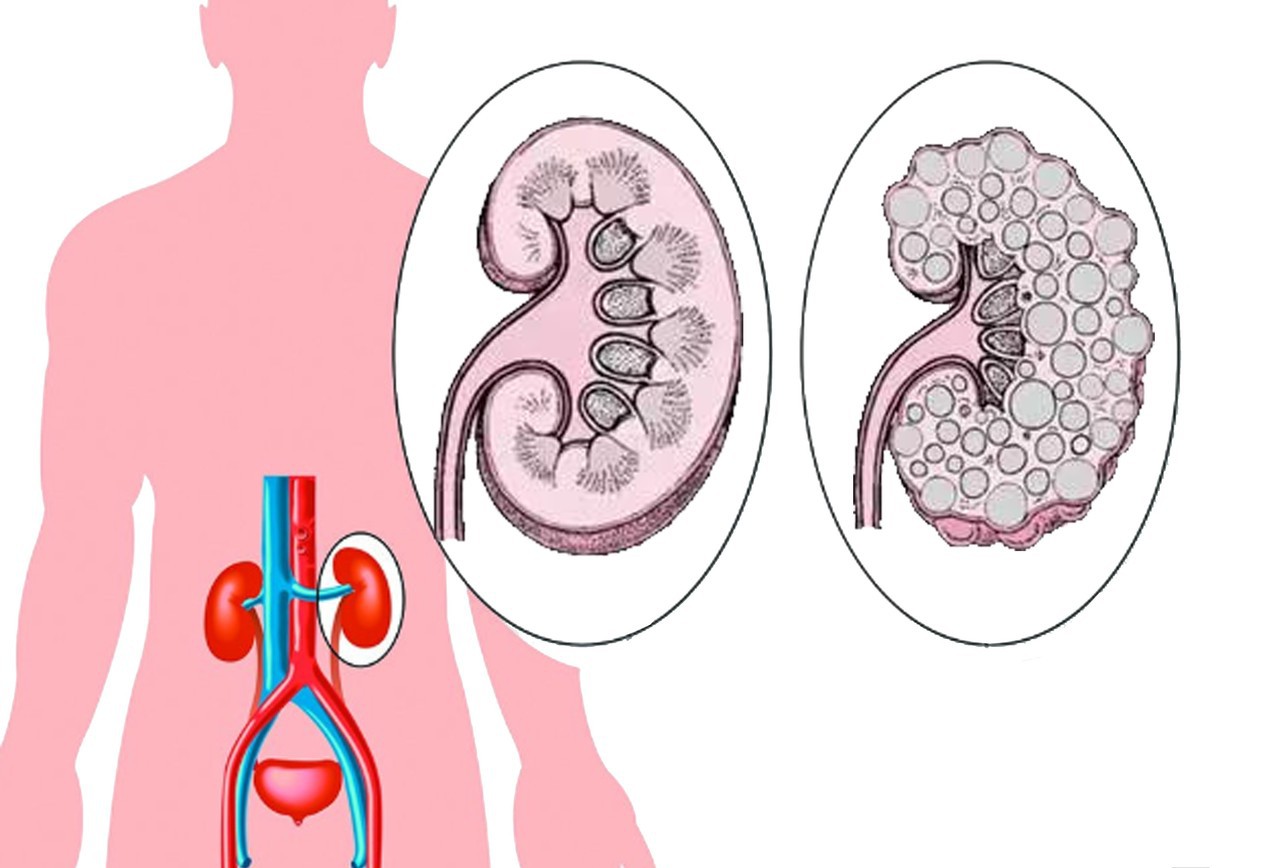 圖一、正常腎臟(左) 及多囊腎臟(右)比較