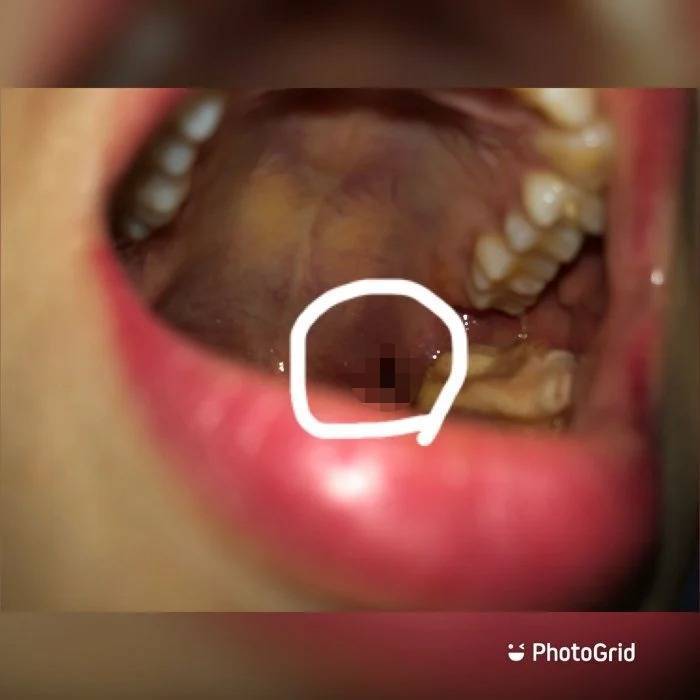一名女網友分享自己拔智齒經驗，沒想到牙醫用電鑽切割牙齒時，竟不慎傷到喉嚨留下可怕傷口。 圖擷自Dcard
