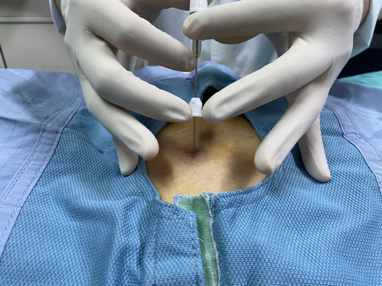 澄清醫院胸腔外科醫師杜承哲以3D內視鏡和單孔微創手術，3天後就回到工作崗位。圖／澄清醫院提供