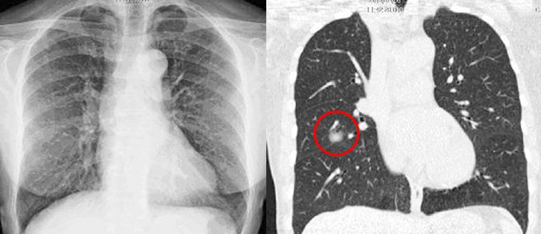 67歲不抽菸的家庭主婦接受胸部X光檢查(圖)沒有異常，但低劑量電腦斷層顯示右中肺...
