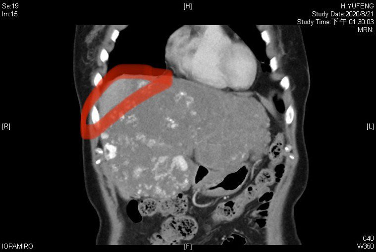 許姓婦人罹患多發性巨大肝血管瘤，正常的肝臟只剩下左上方一小塊。記者徐白櫻／翻攝