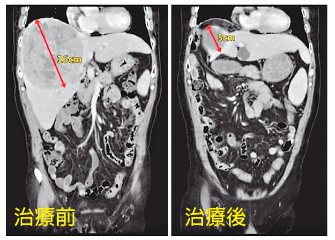 賴先生電腦斷層影像檢查，肝腫瘤治療前後比較。圖／亞洲大學附屬醫院提供