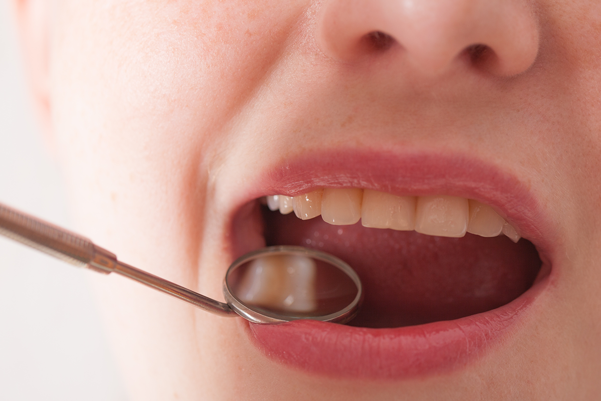 發表在《BMJ》上的一項新研究中，來自美國哈佛大學陳曾熙公共衛生學院的研究人員報告指出：牙齦不健康，罹患胃癌、食道癌等等風險更高。<br />圖／ingimage