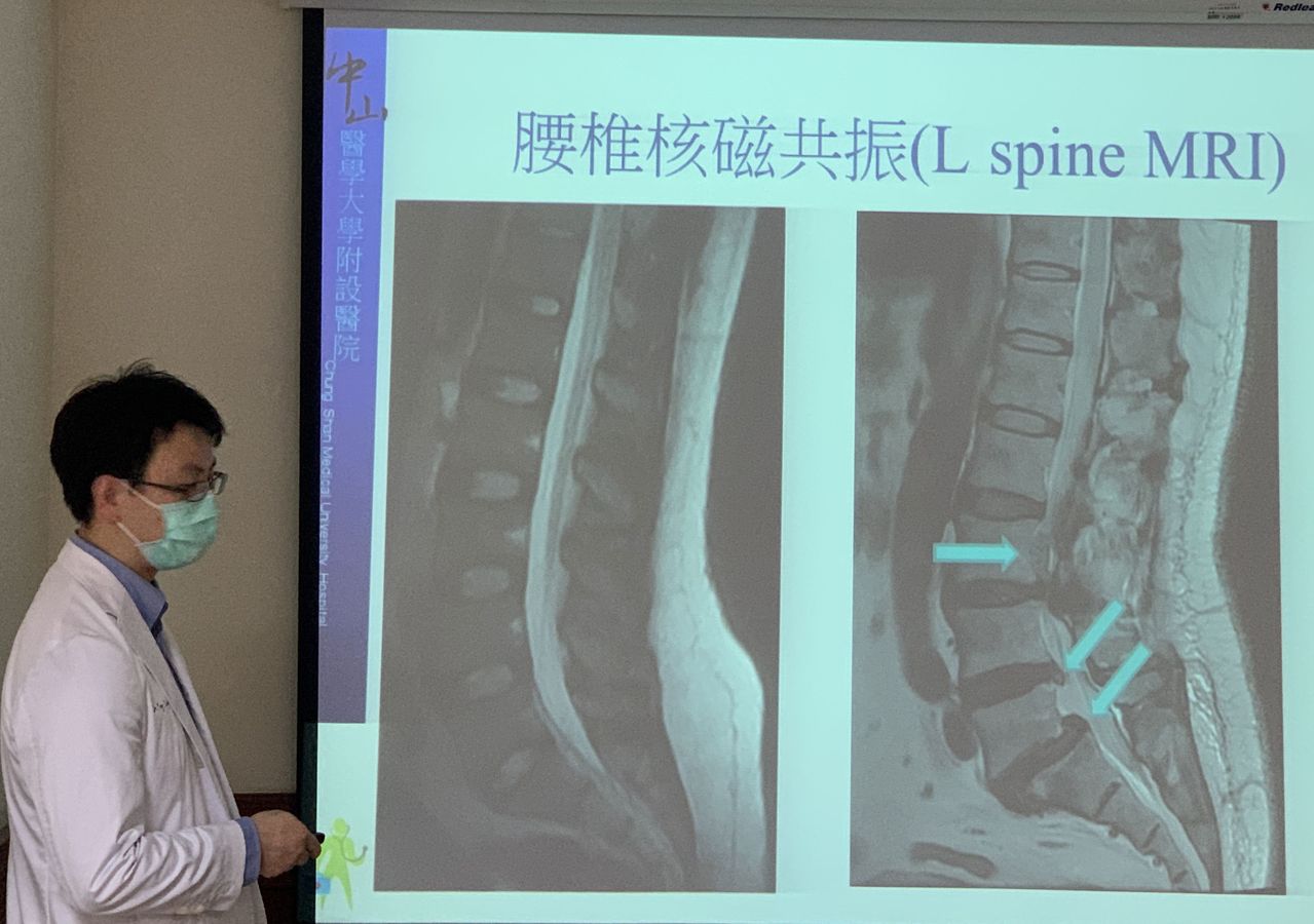 醫師楊宗熹指出腰椎椎間盤突出，易造成急性下肢麻痛。圖／中山附醫提供