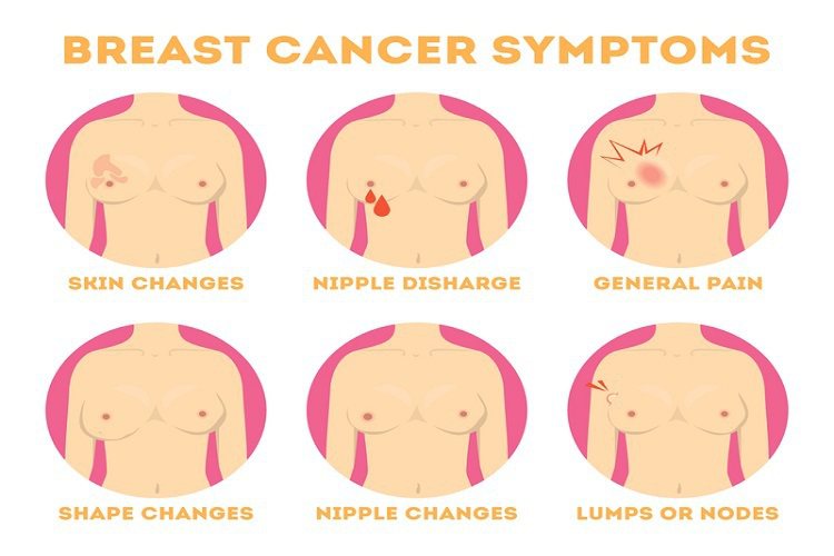 男性乳癌症狀與女性相同？ 早期幾乎無感！胸部有這些特徵要警惕