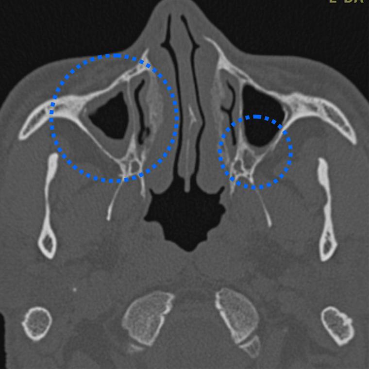 久咳不癒的患者出現咳嗽頭痛，電腦斷層檢查顯示是兩側慢性鼻竇炎 (藍色圈所示為鼻竇...
