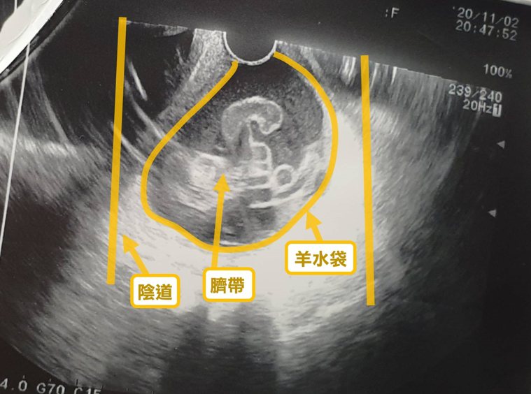 醫師表示，臍帶脫垂容易造成胎兒缺氧，非常危險。圖／門諾醫院提供