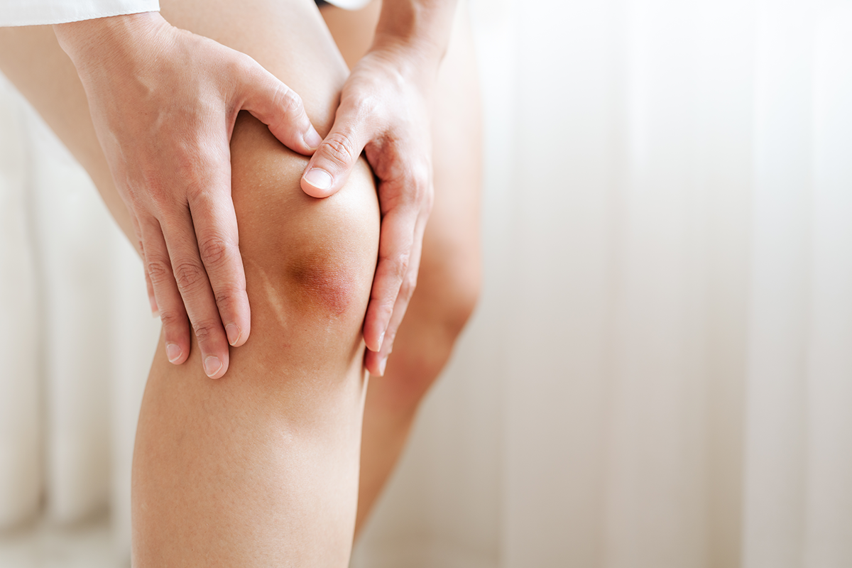 膝蓋痛初期會出現的症狀也是炎症。發生急性炎症的話，微血管會擴張使患部血流增加。血液成分會從擴張處的血管流出來，導致組織浮腫，產生「腫脹」。