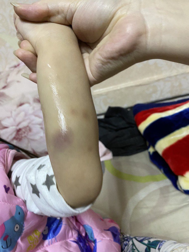 醫師蘇旻昱分享，二歲半女娃尿布上面都是血，身上多處瘀青，甚至手臂有腫脹血塊，經就...