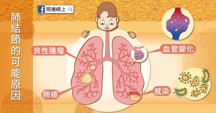 鍾沛君右肺異常開刀 醫師告訴你肺結節到底是不是肺癌