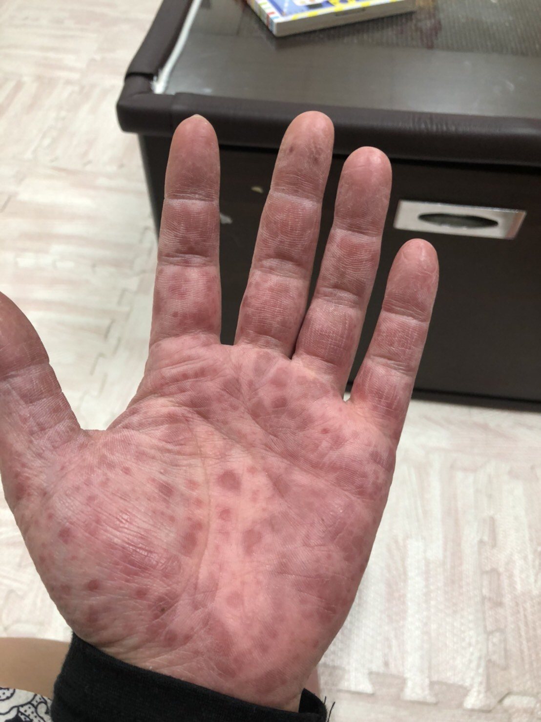 陳先生的手、腳出現明顯疹子。圖／豐原醫院提供