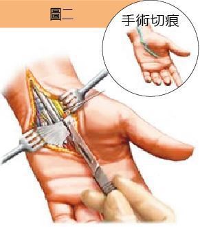 傳統正中神經解離手術，約7-8公分的切痕解離相關沾黏組織。圖／陳志鎧醫師提供
