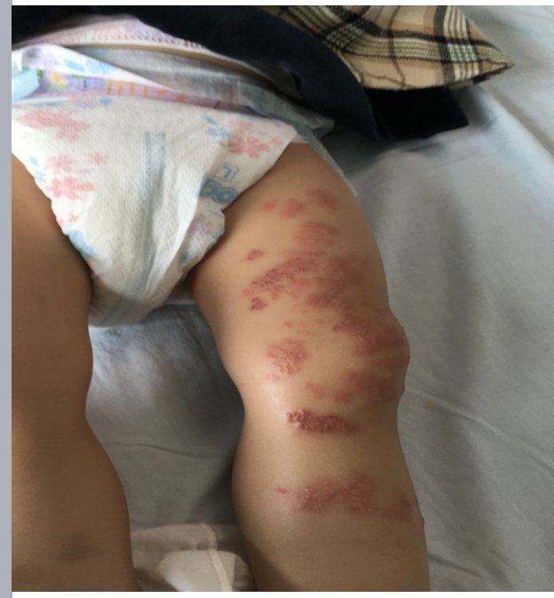 台南市兩歲女童注射水痘疫苗後得到帶狀皰疹。圖／郭綜合提供