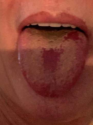 英國流行病學專家斯佩克特教授近日貼出一張舌頭照片，只見上頭有不尋常的變色舌苔。專家警告這可能為新冠病毒的最新症狀，稱作「新冠舌頭」。TWITTER／@timspector