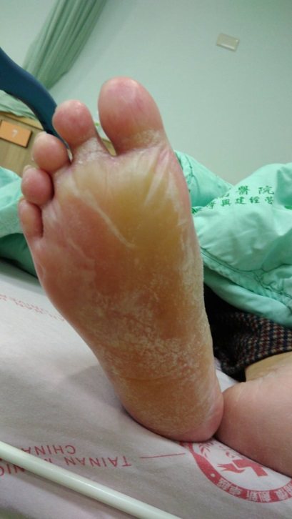 台南市一名78歲老婦腳底被電暖器燙出一個大水泡，幾乎整個腳底都被含蓋。圖／安南醫院提供