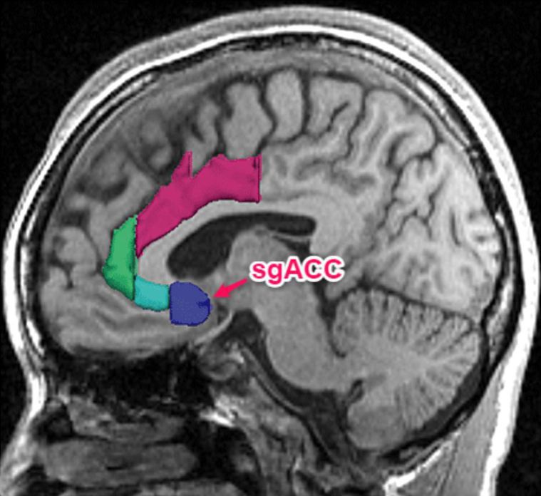 大腦灰質的膝下前扣帶皮質(subgenual anterior cingulat...