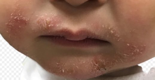 一名10個月大的男嬰因嘴巴周圍紅疹，且明顯身高不足，被診斷出是因缺鋅造成，經補充...