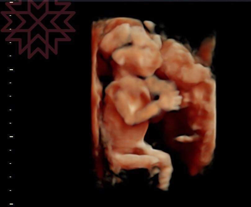 巴鈺秀出寶寶超音波照片。圖／摘自臉書