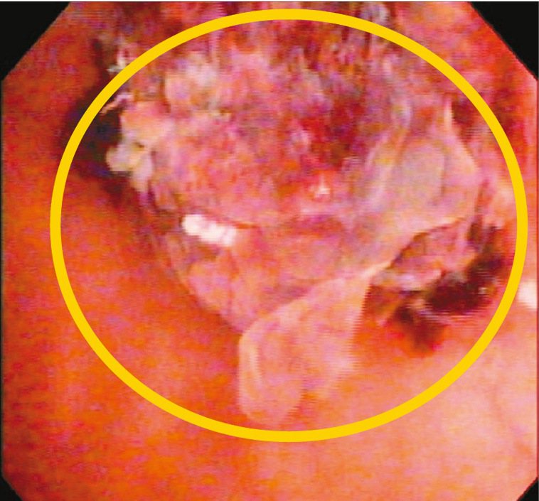 透過膀胱鏡，可見膀胱腫瘤破裂出血(圖)，所以產生肉眼可見的血尿。膀胱左側壁有陰影...