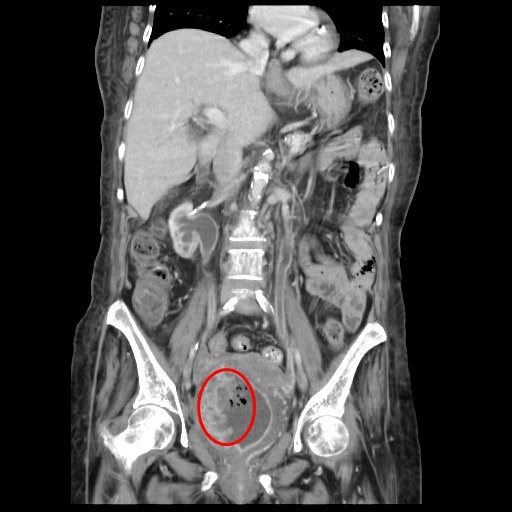 醫師林軒任說明，蔡姓病患的電腦斷層影像顯示，膀胱壁有不規則增厚（紅圈處）。 圖／...