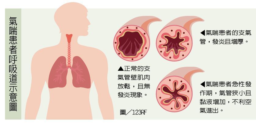 氣喘患者呼吸道示意圖 圖/123RF 製表/元氣周報