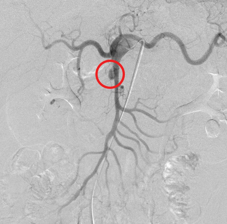 上腸繫膜動脈剝離性動脈瘤(紅圈處)。圖／光田綜合醫院提供