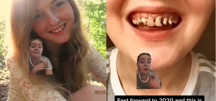 一位美國少女本來有口亮麗的牙齒（圖左），然而長年喝攤酸飲料、抽菸之下，整口牙齒竟...