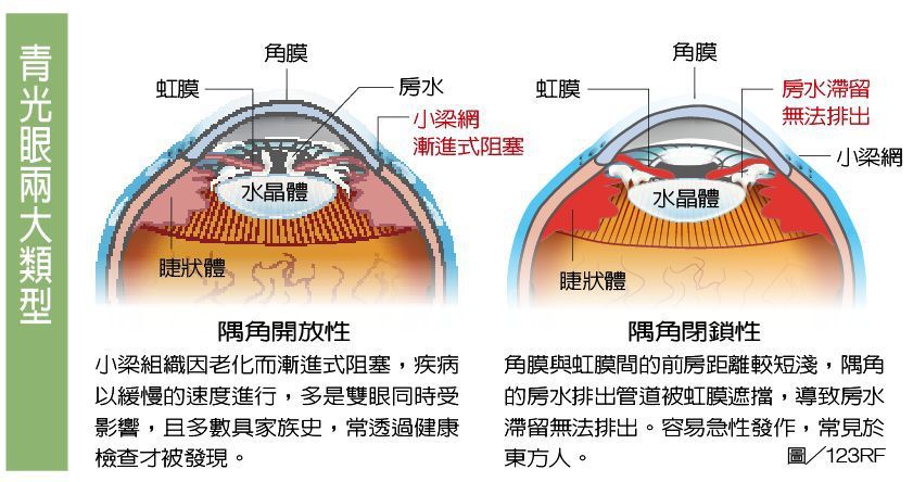 青光眼兩大類型 圖/123RF 製表/元氣周報