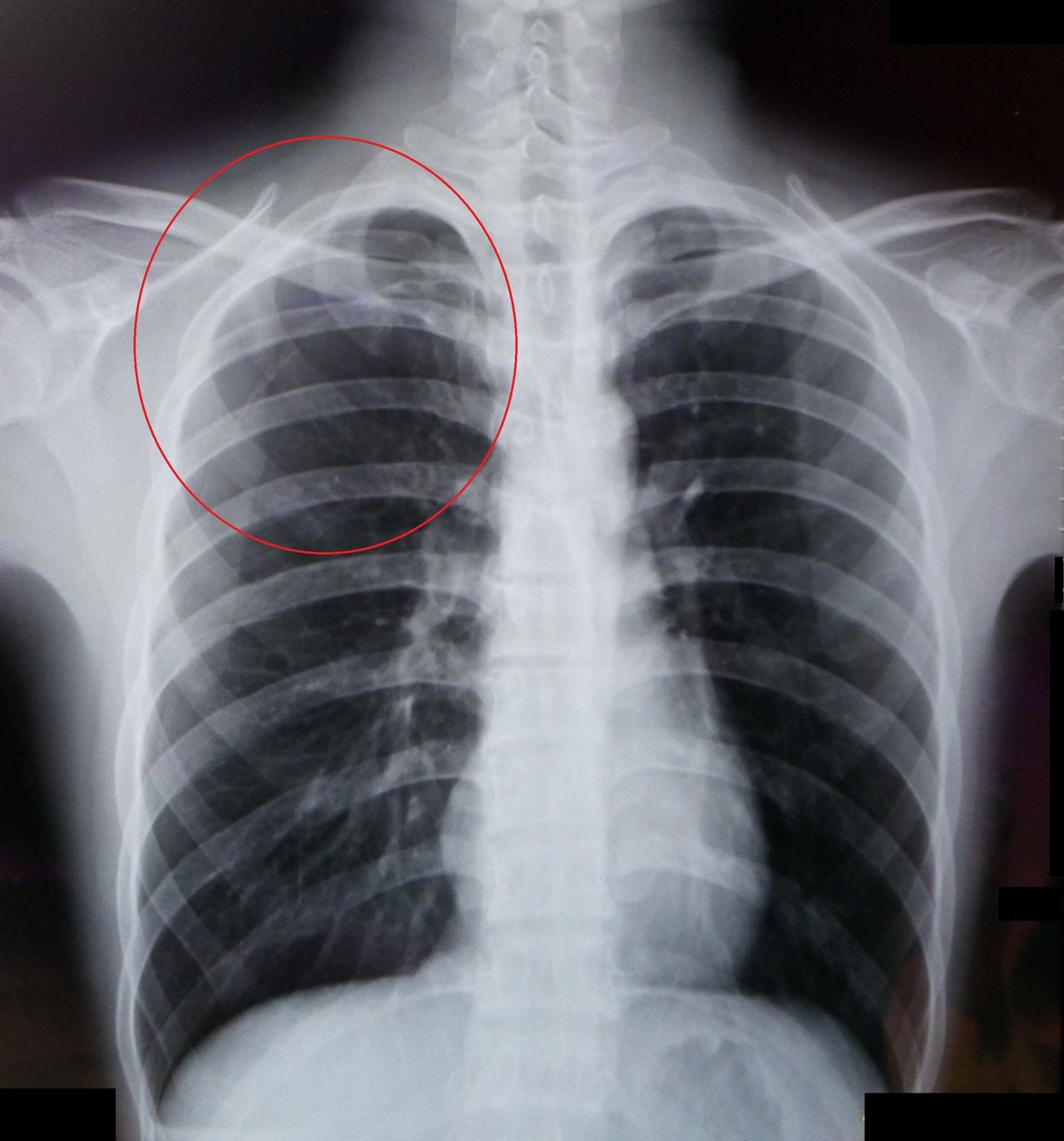 李姓病患這次發生第5次氣胸(紅圈處)，醫師建議接受微創手術，可大幅降低復發率。圖／大千綜合醫院提供