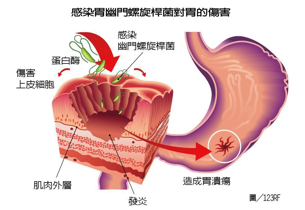 感染胃幽門螺旋桿菌對胃的傷害    製表/元氣周報  圖/123RF