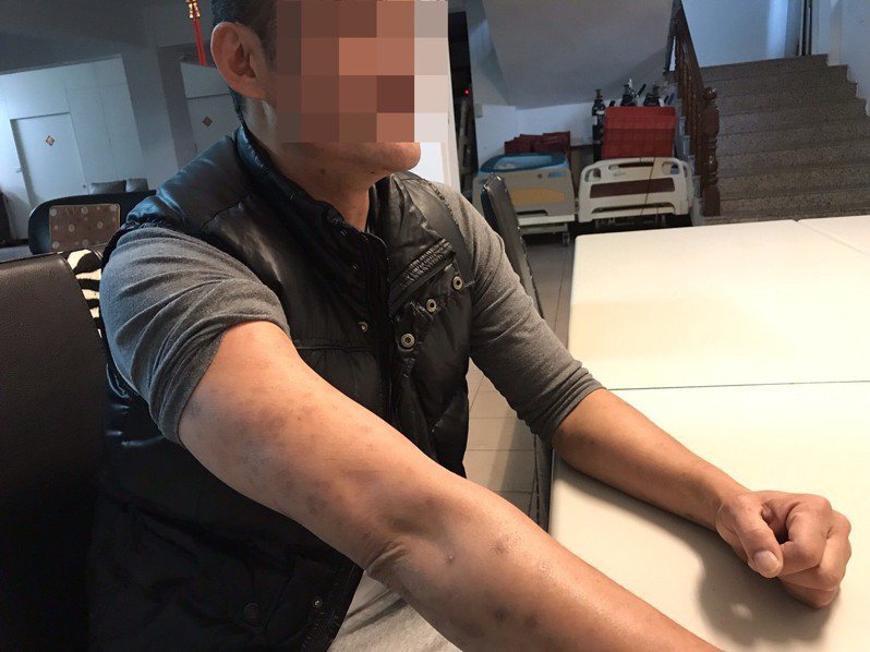 40歲的阿雄，是台灣第一批愛滋感染者。採訪當天，阿雄摸著手上的皮疹疤痕，笑笑地說「很多人看到我的皮膚還是會害怕。」記者馮靖惠／攝影