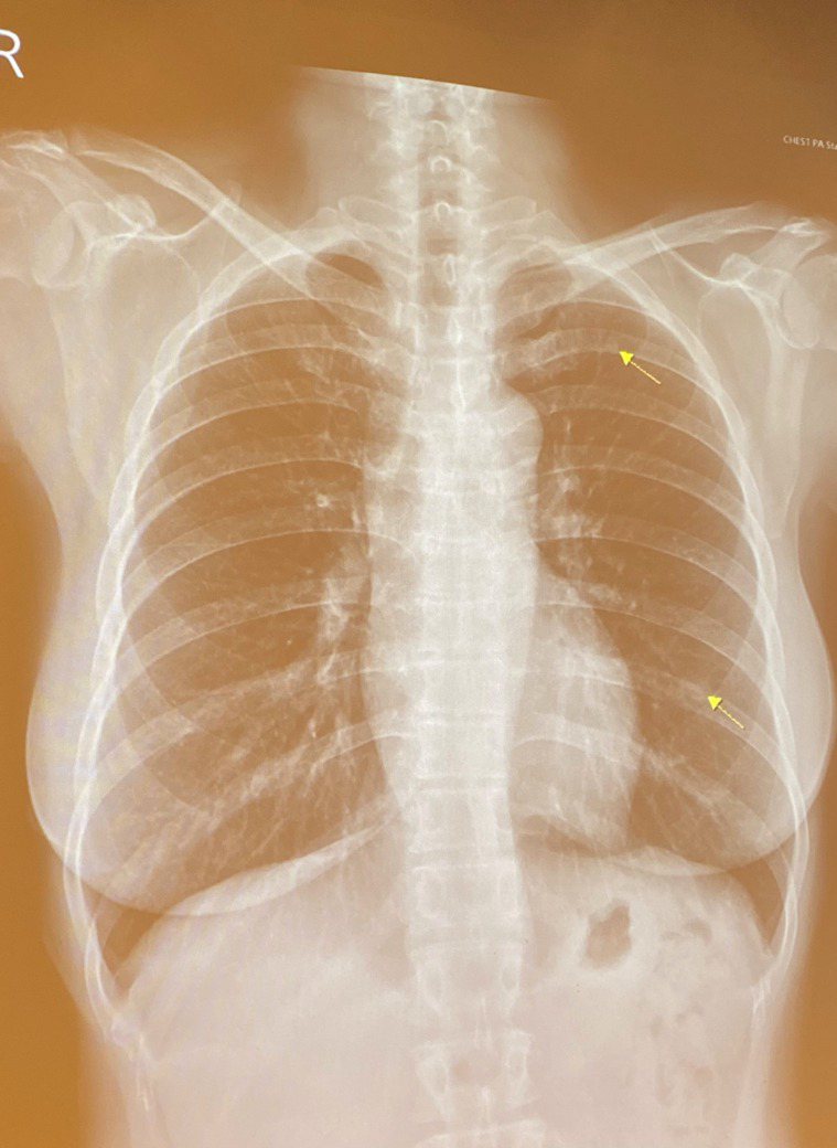 奇美醫院胸腔外科醫師蘇英傑今天報告一個一口氣長出10顆原發性肺癌的罕見病例。記者...