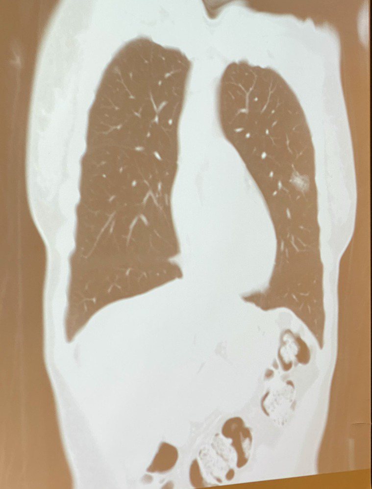 奇美醫院胸腔外科醫師蘇英傑今天報告一個一口氣長出10顆原發性肺癌的罕見病例。記者...