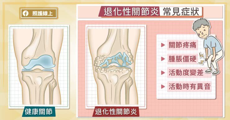 從患者走進診間的步態，膝蓋變形的狀況，大概可以推測退化性關節炎的嚴重程度。 圖／...