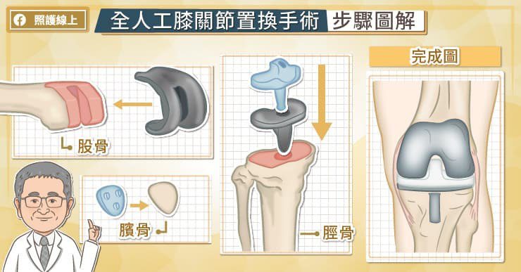 人工膝關節有三個主要結構，分別植入在股骨、脛骨、髕骨。 圖／照護線上