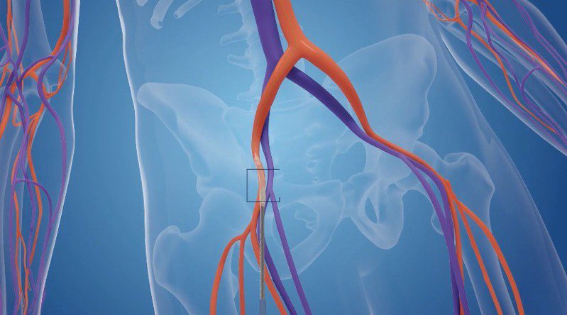 步驟1：從鼠蹊部的動脈置入導管。圖╱台北榮總心臟移植及人工心臟中心主任張效煌提供