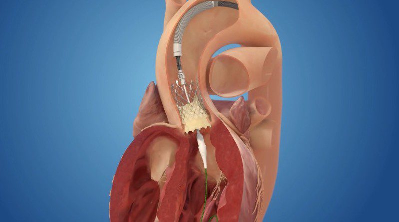 步驟3：撐開並固定人工瓣膜後，退出導管。圖╱台北榮總心臟移植及人工心臟中心主任張效煌提供