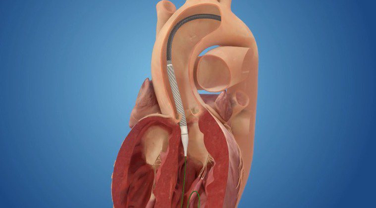 經導管主動脈瓣膜置換術4步驟 2.導管抵達狹窄的主動脈瓣膜處。圖╱台北榮總心臟移...
