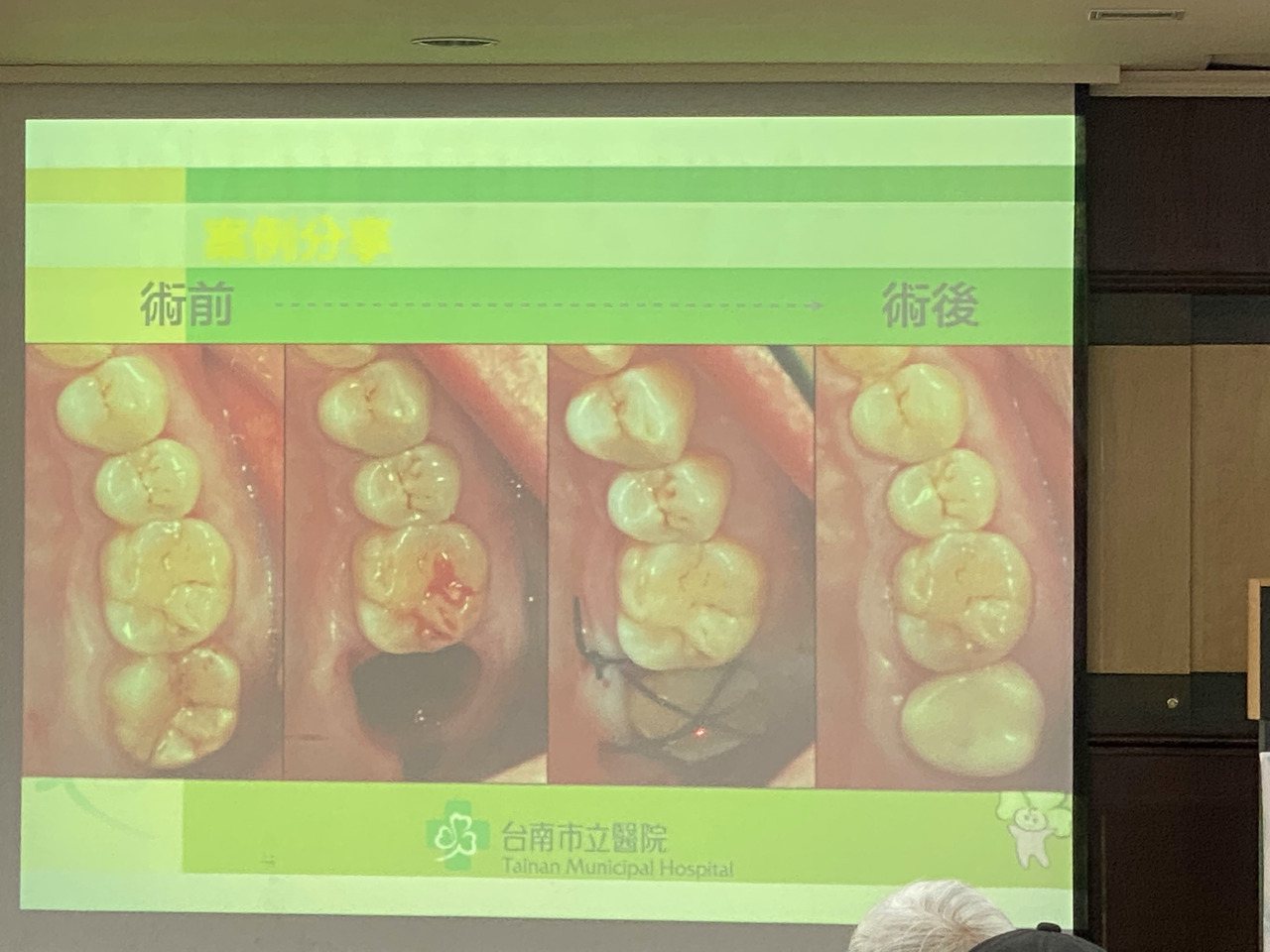 台南市立醫院牙科醫師鍾瑞哲公布自體移植牙齒的案例。記者修瑞瑩／攝影
