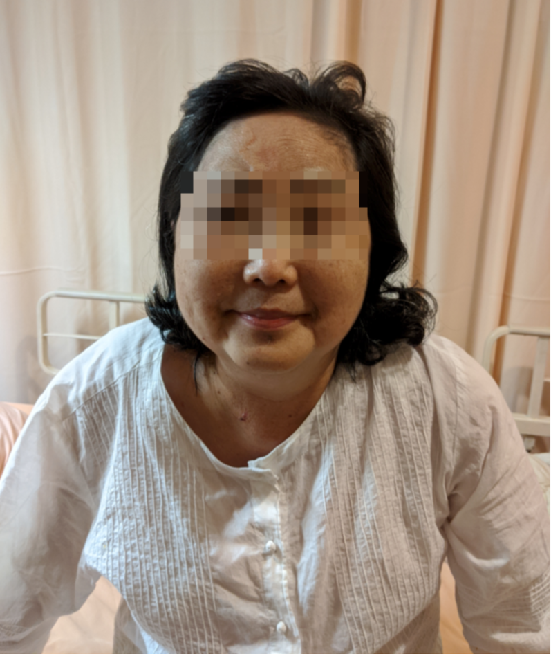 罹患庫欣氏症的張姓婦人出現月亮臉、水牛肩等典型症狀。圖／台北慈濟醫院提供