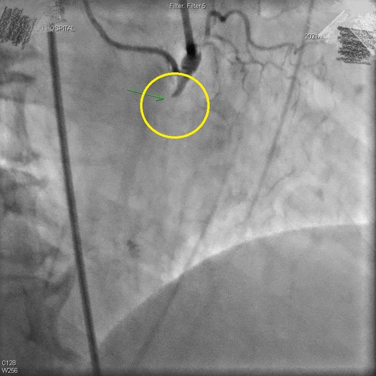 陳姓患者右冠狀動脈近端完全阻塞（黃圈處），心臟功能大幅受影響。圖／南投醫院提供
