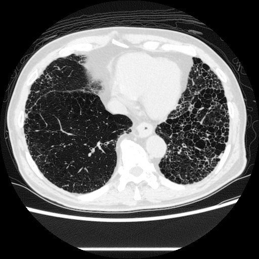 高解析度電腦斷層掃描顯示，特發性肺纖維化如蜂窩狀，像菜瓜布。圖／詹明澄提供