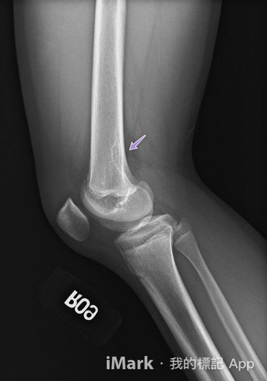 台北榮總骨腫瘤中心主任吳博貴指出，在X光影像中，非骨化纖維瘤看似骨骼破了一個大洞...